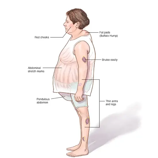 cushings syndrome package test